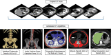 Automated CT-based cardiometabolic tools for assessment of (second row of images, left to right) bone, aortic calcium, visceral to subcutaneous fat ratio, muscle attenuation, and liver attenuation biomarkers from original abdominal CT data. In practice, a visual correlate allows for quality assurance for the automated segmentation results in individual patients. The specific CT biomarkers shown have all been validated in prior works. (Adapted and reprinted under a CC BY license from reference 23.)