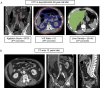 Combining automated CT tools for prediction of future adverse events in an asymptomatic 52-year-old man undergoing CT colonography (CTC) for colorectal cancer screening. A, Coronal (left) and axial (middle and right) screening images show calcification (red shading, left), the visceral (blue shading, middle) to subcutaneous (red shading, middle) fat ratio, and liver attenuation (green shading). This patient had a body mass index of 27.3 and an FRS of 5% (low risk). However, several CT-based metabolic markers were indicative of underlying disease (values and percentiles provided). The patient had an acute myocardial infarction 3 years after this initial CT examination and died 12 years after the initial CT examination at the age of 64 years. B, Axial (left), coronal (middle), and sagittal (right) contrast-enhanced CT images acquired for minor trauma 7 months before death were interpreted as negative for abnormalities but show substantial progression of vascular calcification, visceral fat, and hepatic steatosis. (Adapted and reprinted under a CC BY license from reference 23.)