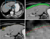 Semiautomated measurement of the liver surface nodularity score for detection of hepatic fibrosis and cirrhosis. Axial contrast-enhanced CT image (top left) of the liver in a patient with a hepatitis C virus infection who had not previously been evaluated with biopsy or noninvasive methods for liver fibrosis shows a cirrhotic liver with a nodular surface and trace ascites. The blue box shows the area that is magnified (magnification, ×2.5) and appears in the upper right image, which shows how the liver is manually painted with the green brush stroke. Axial contrast-enhanced CT image (bottom left) shows automatic detection of the liver. The yellow box indicates the area that is magnified in the corresponding bottom right image. (Magnification, ×30.) The green line represents the automatically detected liver surface, and the red line is a smoothed polynomial line (spline) fit to represent a smooth liver surface. The distances between the detected edge and spline are measured on a pixel-by-pixel basis, with approximately 100 measurements per section (bottom right) and 1000 measurements for the recommended 10 sections (not shown). The liver surface nodularity score in this case was 4.8, which is considered severe cirrhosis. (Case courtesy of Andrew D. Smith, MD.)