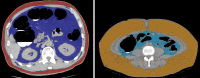 Visceral and subcutaneous fat segmentation and quantification at CT in two asymptomatic obese adults with similar body mass index levels but different body habitus. Axial CT image (left), which was acquired with the use of the automated fat tool in a 67-year-old man, shows a relative abundance of visceral fat (blue shading) compared with subcutaneous fat (red shading), whereas the other axial CT image (right), for which an earlier semiautomated fat tool was used at the umbilical level in a 52-year-old woman, shows a relative abundance of subcutaneous fat (orange shading) in comparison to visceral fat (light blue shading). These findings show the difference between so-called apple- and pear-shaped body habitus, respectively. This difference can be quantified with the visceral to subcutaneous fat ratio. The increased visceral to subcutaneous fat ratio for the patient on the left portends a higher cardiovascular risk.