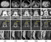 (a) CT-based assessment of bone mineral density with the use of trabecular attenuation at the L1 vertebral level. Axial CT images show the L1 vertebral level (top row) in adult patients of a variety of ages. Magnified axial CT views show the L1 vertebra in soft tissue (second row) and bone (third row) windows. Standard manual placement of the ROI for measurement of trabecular attenuation and the mean attenuation value in the ROI are shown in the third row. Automated ROI placement was programmed to match this location. Sagittal reconstruction images (bottom row, soft-tissue [left] and bone [right] windows) show placement of the ROI (yellow oval) at the L1 vertebra. Typically, trabecular attenuation values progressively decrease with increasing patient age. The loss of bone mineral density is more apparent with the soft-tissue window. (Reprinted, with permission, from reference 39.) (b) Graph (left) shows normative reference CT-based L1 trabecular attenuation values based on more than 20 000 examinations. The mean attenuation values show that age-related L1 trabecular bone loss is fairly linear. Error bars indicate standard deviations, which are remarkably uniform throughout the age spectrum. Table (right) shows the median and the mean (± standard deviation [SD] ) values for L1 trabecular attenuation for each age group. These normative reference ranges, which are derived from a combination of manual and automated measurements, can serve as a quick reference for radiologists when reading body CT examinations performed for other clinical indications. Note that these values apply to scanning at 120 kVp. (Reprinted, with permission, from reference 37.)
