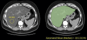Automated versus manual liver fat quantification at noncontrast CT. (a) CT images at the same level show manual (left) and automated (right) methods for measuring liver attenuation (yellow circle, left; green shading, right) in an asymptomatic 60-year-old man with severe steatosis. (b) Scatterplot shows that the results of the manual ROI technique agree well with those of the automated volumetric approach. (Adapted and reprinted, with permission, from reference 20.)