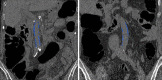Quantification of abdominal aortic calcification with a semiautomated CT tool. (a) Coronal CT images in two different asymptomatic adults show segmentation of aortic calcium (blue shading) with a semiautomated software tool originally devised for coronary artery calcium scoring. Abdominal aortic calcium is segmented in an ROI that is specified by the user. (b) Superimposed receiver operating characteristic curves for cardiovascular events occurring within a 2-year period after CT show a corresponding area under the curve of 0.82 for abdominal aortic calcification (AAC) and 0.64 for the FRS. Adding the FRS to the AAC did not improve predictive performance (area under the curve, 0.82). (Fig 6b reprinted, with permission, from reference 12.)