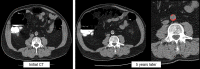 Change in the automated abdominal aortic calcium level over time in an asymptomatic 60-year-old man undergoing noncontrast CT for colonographic screening. Axial image from index CT examination (left) shows moderate hard plaque involving the abdominal aorta, which corresponds to an automated Agatston score of 1514. Axial CT images acquired 5 years later (middle and right) show an interval increase in hard plaque (red shading, right) that corresponds to an automated Agatston score of 5070. The patient experienced a myocardial infarction 4 years after the second CT examination and developed congestive heart failure 3 years after that.
