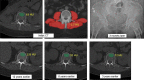 CT for prediction of an osteoporotic fracture in an asymptomatic 59-year-old woman undergoing colorectal cancer screening. Index axial CT images (top row, left and middle) show results from automated assessment of bone with the automated placement of the bone mineral density ROI (green oval, top row, left) (63 HU) and muscle (−1.7 HU) attenuation (red shading, top row, middle), which were in the 99th and 98th percentiles, respectively, relative to the entire screening study cohort. However, the 10-year FRAX scores for this patient were 6.7% for any fracture and 0.5% for hip fracture, which are results well below the recommended treatment threshold. Frontal radiograph (top row, right) from 3 months later shows that the patient sustained a left femoral neck fracture. Axial noncontrast CT images (bottom row) from multiple prior examinations for urolithiasis over the years show, in retrospect, a progressive decrease in L1 bone attenuation at the ROI (green oval, automated measures shown). Unfortunately, this information is typically not considered in routine clinical practice for CT examinations performed for other indications. (Adapted and reprinted, with permission, from reference 24.)