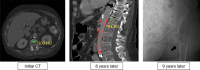 Opportunistic CT measurement of L1 trabecular attenuation in an asymptomatic 76-year-old woman who presented with abdominal pain due to mild pancreatitis. Axial contrast-enhanced CT image (left) shows the relative placement of the automated bone mineral density ROI (green oval) in the anterior trabecular space of the L1 vertebral body. An attenuation value of 100 HU indicates low bone mineral density. Placement of the ROI was intended to match that placed with the previously established manual approach. Sagittal CT image (middle) from an examination performed 8 years later for unintended weight loss shows manual placement of the L1 ROI and an attenuation value of 81 HU, which indicates osteoporosis. An interval vertebral compression fracture at T11 (arrow) is now seen. Note also the depiction of abdominal aortic calcium quantification (red shading) between the L1 and L4 vertebral levels. Frontal radiograph (right) obtained 9 years after the initial CT examination shows a left hip fracture (arrow), the risk for which could have been identified at an earlier CT examination.