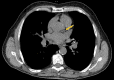 Non-gated coronary calcium scoring. Noncontrast CT image obtained without gating in a 71-year-old man shows automated segmentation of left coronary artery calcification (orange shading) with a validated deep-learning algorithm. The Agatston score was 611. Although most abdominal CT examinations do not include imaging the heart in its entirety, even partial coverage showing a calcium score greater than 400 signifies a high risk for a future adverse event. (Case courtesy of Einav Blumenfeld, Zebra Medical Systems.)