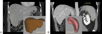 Automated hepatosplenic volumetry for improved assessment of hepatomegaly and splenomegaly. A, Coronal CT image in a 59-year-old woman shows a bulbous-appearing liver, but the maximal craniocaudal length was less than 20 cm. However, the automated liver volume was 2573 cm3, which is well above the upper limit of normal, derived as two standard deviations higher than the mean, as we describe in a currently unpublished study of an asymptomatic cohort. The segmented liver is shown on the inset image. B, Similarly, coronal CT image in a 45-year-old man shows a long-axis splenic measurement of greater than 12 cm, but the automated splenic volume of 277 cm3 is well within the upper limit of the normal range and was established in a similar way. The segmented spleen is shown on the inset image. Note the normal crescentic shape of the spleen.