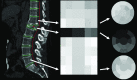 Automated detection of a vertebral fracture with two different algorithms in two patients. (a) Composite CT image in a 62-year-old woman with a severe osteoporotic compression fracture of the L1 vertebral body shows the use of an algorithm for automated detection and characterization of fractures that involves the use of a height compass approach (red and green lines, left). The geometric arrangement of the compass-like layout consists of a central circular sector surrounded by two ring-shaped finite thickness concentric bands. The sagittal CT image (left) shows vertebral column segmentation and partitioning. The adjacent image (right) shows the stacked-height compass of the entire vertebral column. The circular images show the height compasses for a grade-3 wedge fracture at L1 (middle) and preserved vertebral height at T12 (top) and L5 (bottom). The patient underwent spine DXA less than 2 months earlier that was interpreted as normal (T-score, −0.5). (b) Sagittal CT image in an 85-year-old woman shows a severe T11 compression deformity (yellow rectangle), which was detected with a different automated deep-learning algorithm. (Fig 5b courtesy of Einav Blumenfeld, Zebra Medical Systems.)