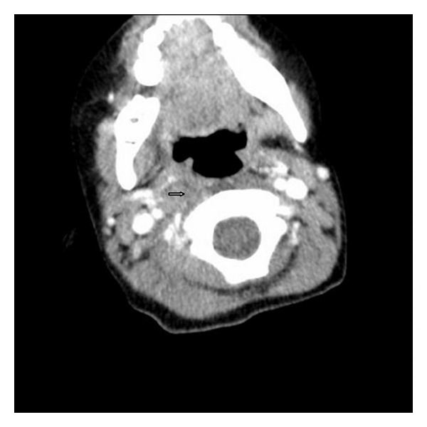 Grisel's Syndrome: A Rare Complication following Adenotonsillectomy - PMC