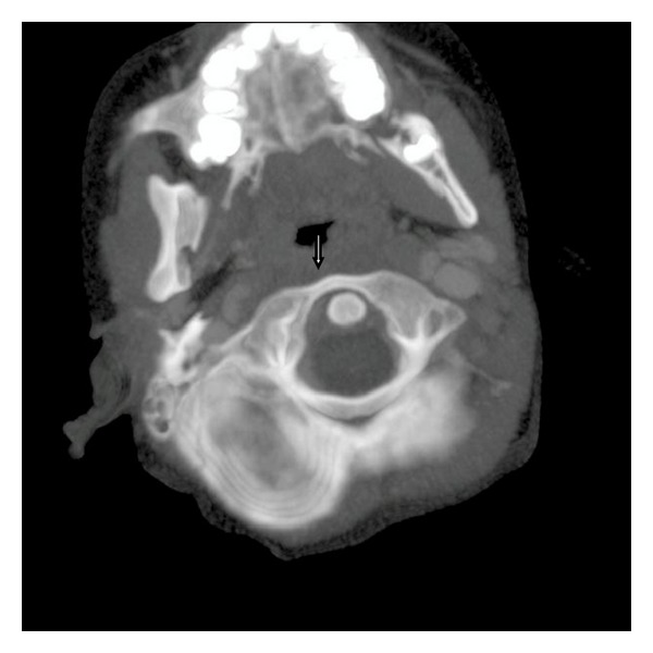 Grisel's Syndrome: A Rare Complication following Adenotonsillectomy - PMC