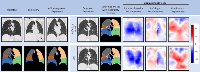 Case example comparing deformed images, segmentations, and displacement fields for the algorithm for performing deformable registration of lung CT (LungRegα,β,γ) and symmetric diffeomorphic registration (iterative) (SyN). Dashed white lines are overlaid inspiratory segmentations. Positive displacements (red) are posterior-to-anterior, left-to-right, and inferior-to-superior. Deformed expiratory images appear similar across LungRegα,β,γ and SyN. However, overlap of lung structures improves, especially for the right middle lobe. Displacement fields suggest similar anatomic transformations between algorithms, but with greater emphasis on the lung boundaries, as evidenced by the lung outline presence visible in each LungRegα,β,γ field.