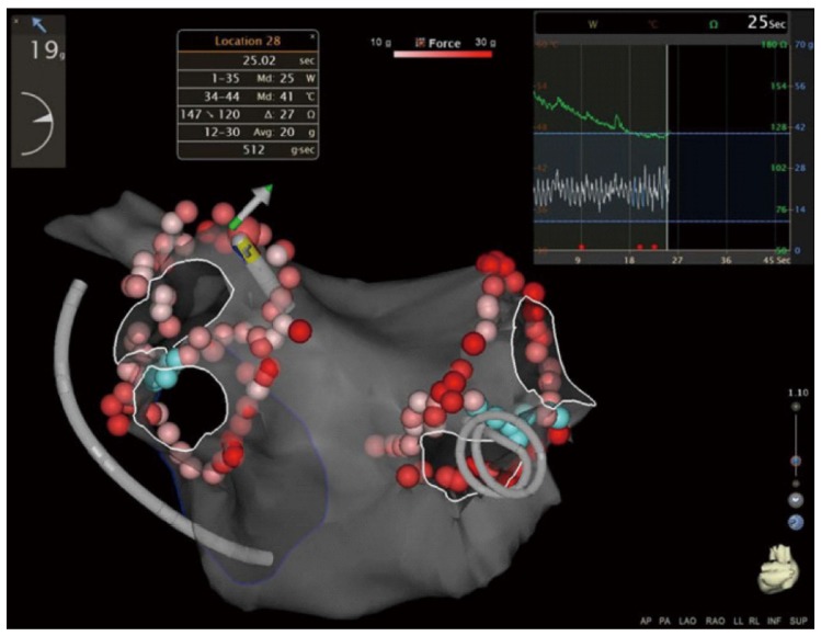 Paroxysmal atrial fibrillation ablation: Achieving permanent pulmonary ...