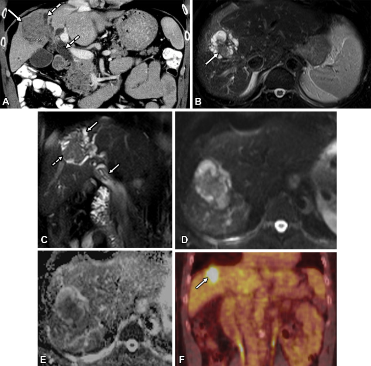 Moderately differentiated invasive adenocarcinoma arising from an intrahepatic IPNB in a 62-year-old man. (A) Coronal contrast-enhanced CT image shows a large intraductal mass (solid arrow) with associated upstream and downstream ductal dilatation (dashed arrows). (B) Axial T2-weighted image shows a lobulated intraductal mass (arrow) with adjacent bile duct dilatation. (C) Coronal T2-weighted image shows an intraductal mass (dashed arrow) with both upstream and downstream ductal dilatation (solid arrows). (D) Axial diffusion-weighted image shows hyperintense signal within the mass. (E) Axial apparent diffusion coefficient (ADC) map shows hypointense signal within the mass, indicative of restricted diffusion and corresponding to invasive tumor. (F) Coronal PET/CT image shows increased metabolic activity in the mass (arrow).