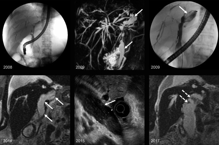 IPNB in a 66-year-old woman with a history of primary sclerosing cholangitis who developed an IPNB over a decade. Top left: Endoscopic retrograde cholangiopancreatography (ERCP) image from 2008 shows multifocal strictures and irregular beaded appearance of the biliary tree, with mild dilatation of the common bile duct (CBD) and left hepatic duct. Top center: Maximum intensity projection image from MRCP in 2009 shows persistent irregular beaded appearance of the biliary tree and progressive dilatation of the CBD and left hepatic duct (arrows). Top right: ERCP image from 2009 shows ductal dilatation with amorphous and cordlike filling defects in the left hepatic duct (arrow). Bottom: Coronal T2-weighted image from 2014 (bottom left), endoscopic US (EUS) image from 2015 (bottom center), and coronal T2-weighted image from 2017 (bottom right) show progressive enlargement of the CBD and common hepatic duct (solid arrows) with small polypoid intraductal masses (dashed arrows).