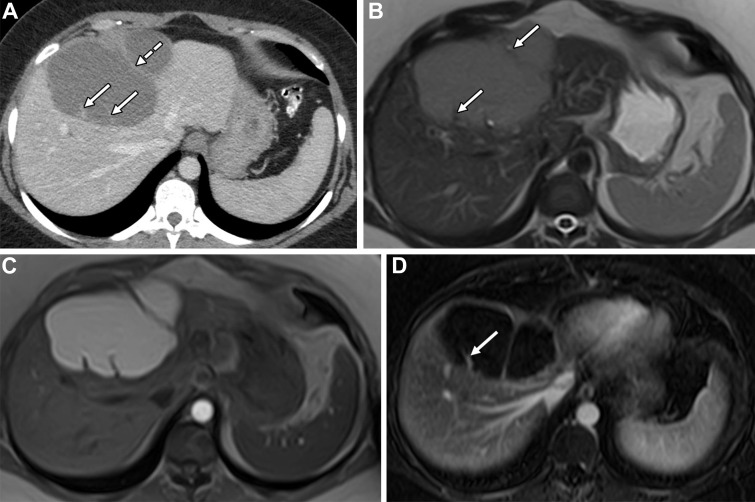 MCN in a 49-year-old woman. (A) Axial contrast-enhanced CT image shows a complex cystic mass in the left hepatic lobe with septa arising from the wall without external indentation or macrolobulation (solid arrows), as well as a septum arising from a macrolobulation (dashed arrow). (B) Axial T2-weighted image shows a large intermediate-signal-intensity mass with septa (arrows). (C) Axial T1-weighted image shows a hyperintense multiseptated mass. (D) Axial contrast-enhanced portal venous phase fat-suppressed T1-weighted image with subtraction shows mild septal enhancement (arrow).