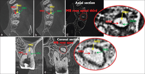 A case report on endodontic management of the rarest Vertucci's Type ...