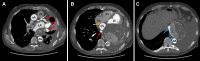 Axial cardiac CT angiographic images demonstrate the presence of a dilated
left circumflex coronary artery with fistula to a dilated coronary sinus (CS)
with ostial atresia and aneurysm. (A) Dilated and tortuous left circumflex
coronary artery (red arrows). (B) Dilated, opacified CS adjacent to the right
atrium (RA) without communication, demonstrating an ostial atresia (yellow
arrow). A large, partially thrombosed aneurysm is visualized with a patent
lumen. Red arrow indicates left circumflex coronary artery. (C) Drainage of the
CS (blue arrows) into lumen of a large, partially calcified, partially
thrombosed aneurysm. See Movie 1 for axial, sagittal, and coronal cuts, and see
Movie 2 for three-dimensional reconstruction. aA = ascending aorta, dA =
descending aorta, L = lumen of aneurysm, LA = left atrium, LV = left ventricle,
PA = pulmonary artery, rPA = right PA, RV = right ventricle, T = thrombus of
aneurysm.