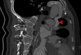 Curved multiplanar reconstruction of cardiac CT angiographic image
demonstrates a partially thrombosed aneurysm (AN) draining superiorly through a
persistent left superior vena cava (red arrowhead), connecting to a left
brachiocephalic vein (LBCV).