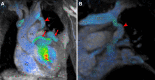 (A, B) Oblique reconstructions of cardiac four-dimensional flow MRI
demonstrate retrograde (cephalad) blood flow through the persistent left
superior vena cava (red arrowhead) into the left brachiocephalic vein (LBCV).
Red arrows indicate left circumflex artery. See Movie 4 (for A) and Movie 5 (for
B) for full loop. aA = ascending aorta, LV = left ventricle, PA = pulmonary
artery, RSVC = right superior vena cava, RV = right ventricle.