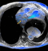 Image from axial cardiac four-dimensional flow MRI demonstrates no flow
(ie, ostial atresia; yellow arrow) between the coronary sinus (CS) and the right
atrium (RA). The flow through cardiac structures can also be appreciated with
minimal flow within the lumen of the aneurysm (L), circular or turbulent flow
within the CS, and linear high flow within the left ventricle (LV) toward the LV
outflow tract. See Movie 3 for full loop. dA = descending aorta, RV = right
ventricle, T = thrombus of aneurysm.