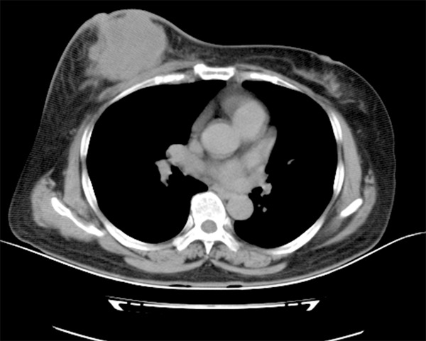 A Rapidly Progressive Giant Tumor With One Year Growth On Breast A a-rapidly-progressive-giant-tumor-with-one-year-growth-on-breast-a