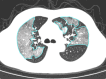 A 53-year-old man with critical COVID-19, axial chest CT images at baseline and follow-up. (a) Baseline: multiple ground-glass opacities are observed in the right and left upper lobes (opacification percentages of right and left lobes: 53.55% and 45.89%, respectively); (b) first follow-up: multiple patchy ground-glass opacities are increased bilaterally, with development of consolidation (opacification percentages of right and left lobes: 59.36% and 67.77%, respectively).