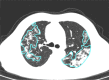 A 56-year-old man with severe COVID-19, axial chest CT images at baseline and follow-up. (a) Baseline: multiple ground-glass opacities are observed in the right and left upper lobes (opacification percentages of right and left lobes: 19.78% and 17.79%, respectively); (b) first follow-up: multiple patchy ground-glass opacities are increased bilaterally (opacification percentages of right and left lobes: 30.39% and 29.72%, respectively); (c) second follow-up: ground-glass opacity is absorbed, with development of consolidation and perilobular pattern (opacification percentages of right and left lobes: 24.21% and 19.73%, respectively).