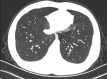 A 29-year-old male patient with mild COVID-19, axial chest CT images at baseline and follow-up. (a) Baseline: negative CT; (b) first follow-up: ground-glass opacity is observed in the left lower lobe (opacification percentage of the left lower lobe: 0.24%); (c) second follow-up: increased size and new ground-glass opacity (opacification percentage of the left lower lobe: 2.55%).