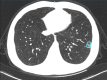 A 29-year-old male patient with mild COVID-19, axial chest CT images at baseline and follow-up. (a) Baseline: negative CT; (b) first follow-up: ground-glass opacity is observed in the left lower lobe (opacification percentage of the left lower lobe: 0.24%); (c) second follow-up: increased size and new ground-glass opacity (opacification percentage of the left lower lobe: 2.55%).