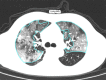 A 53-year-old man with critical COVID-19, axial chest CT images at baseline and follow-up. (a) Baseline: multiple ground-glass opacities are observed in the right and left upper lobes (opacification percentages of right and left lobes: 53.55% and 45.89%, respectively); (b) first follow-up: multiple patchy ground-glass opacities are increased bilaterally, with development of consolidation (opacification percentages of right and left lobes: 59.36% and 67.77%, respectively).