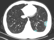 A 29-year-old male patient with mild COVID-19, axial chest CT images at baseline and follow-up. (a) Baseline: negative CT; (b) first follow-up: ground-glass opacity is observed in the left lower lobe (opacification percentage of the left lower lobe: 0.24%); (c) second follow-up: increased size and new ground-glass opacity (opacification percentage of the left lower lobe: 2.55%).