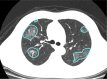 A 56-year-old man with severe COVID-19, axial chest CT images at baseline and follow-up. (a) Baseline: multiple ground-glass opacities are observed in the right and left upper lobes (opacification percentages of right and left lobes: 19.78% and 17.79%, respectively); (b) first follow-up: multiple patchy ground-glass opacities are increased bilaterally (opacification percentages of right and left lobes: 30.39% and 29.72%, respectively); (c) second follow-up: ground-glass opacity is absorbed, with development of consolidation and perilobular pattern (opacification percentages of right and left lobes: 24.21% and 19.73%, respectively).