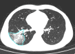 A 41-year-old man with moderate COVID-19, axial chest CT images at baseline and follow-up. (a) Baseline: ground-glass opacity is found in the right lower lobe (opacification percentage of the right lower lobe: 1.33%); (b) first follow-up: increased patchy ground-glass opacity with new consolidation in the right lower lobe (opacification percentage of the right lower lobe: 12.56%); (c) second follow-up: ground-glass opacity is partially absorbed and development of perilobular pattern (opacification percentage of the right lower lobe: 9.28%).