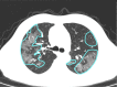 A 56-year-old man with severe COVID-19, axial chest CT images at baseline and follow-up. (a) Baseline: multiple ground-glass opacities are observed in the right and left upper lobes (opacification percentages of right and left lobes: 19.78% and 17.79%, respectively); (b) first follow-up: multiple patchy ground-glass opacities are increased bilaterally (opacification percentages of right and left lobes: 30.39% and 29.72%, respectively); (c) second follow-up: ground-glass opacity is absorbed, with development of consolidation and perilobular pattern (opacification percentages of right and left lobes: 24.21% and 19.73%, respectively).