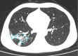 A 41-year-old man with moderate COVID-19, axial chest CT images at baseline and follow-up. (a) Baseline: ground-glass opacity is found in the right lower lobe (opacification percentage of the right lower lobe: 1.33%); (b) first follow-up: increased patchy ground-glass opacity with new consolidation in the right lower lobe (opacification percentage of the right lower lobe: 12.56%); (c) second follow-up: ground-glass opacity is partially absorbed and development of perilobular pattern (opacification percentage of the right lower lobe: 9.28%).