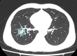 A 41-year-old man with moderate COVID-19, axial chest CT images at baseline and follow-up. (a) Baseline: ground-glass opacity is found in the right lower lobe (opacification percentage of the right lower lobe: 1.33%); (b) first follow-up: increased patchy ground-glass opacity with new consolidation in the right lower lobe (opacification percentage of the right lower lobe: 12.56%); (c) second follow-up: ground-glass opacity is partially absorbed and development of perilobular pattern (opacification percentage of the right lower lobe: 9.28%).