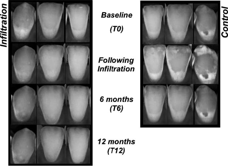 Figure 2. An example of spectrophotometric recordings of one subject. Nontreated control teeth were also infiltrated after 6 months as part of an agreement with the patients. There was a typical temporary increase in lightness of control teeth after the infiltration appointment, which is an effect of desiccation. Overall, esthetic concealment of white-spot lesions worked out better in more superficial lesions, though the appearance of deeper lesions also benefits from resin infiltration, as evident from the depicted lower canine.