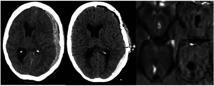 The eyes have it: duret haemorrhage after traumatic subdural haematoma ...