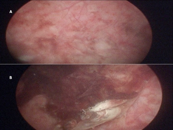 Leukoplakia of the urinary bladder: keratinising squamous metaplasia - PMC