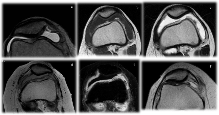 Diagnostic And Interventional Radiology Fundamentals Of Synovial Pathology - PMC