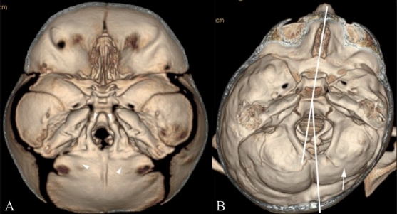 Figure 11(A, B)