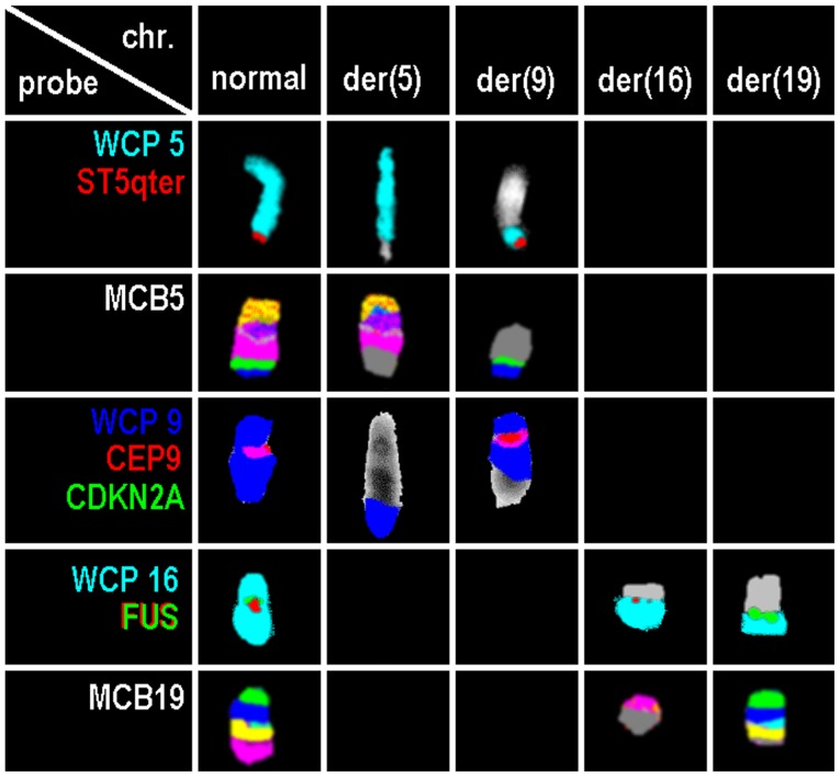 Complex karyotype with cryptic FUS gene rearrangement and deletion of ...