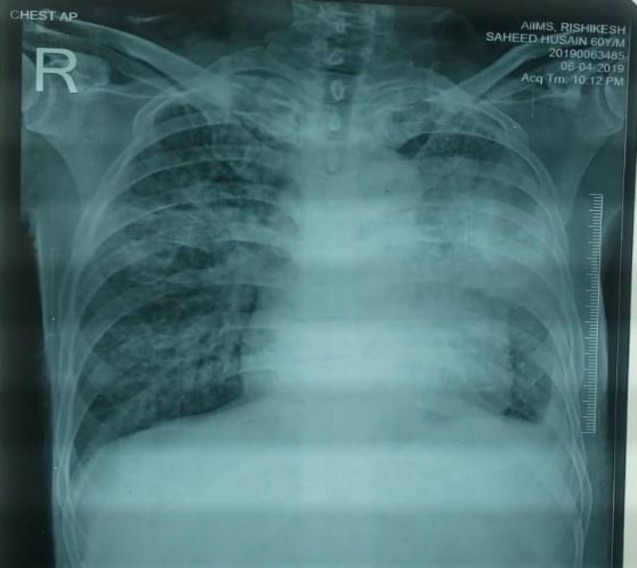 Disseminated Cryptococcosis And Hepatitis C Virus Infection A Fatal Co Infection Pmc