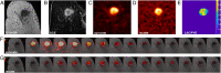 Hyperpolarized [1–carbon 13]pyruvate MR images in a patient
with triple-negative breast cancer. (A) Coronal T1-weighted
three-dimensional spoiled gradient-echo (SPGR) image. (B) Coronal
reformatted dynamic contrast-enhanced (DCE) image at peak enhancement after
injection of a gadolinium-based contrast agent. (C) Summed hyperpolarized
carbon 13 pyruvate images. (D) Summed hyperpolarized carbon 13 lactate
images. (E) Lactate:pyruvate (LAC/PYR) ratio map. (F, G) Dynamic
hyperpolarized carbon 13 pyruvate and lactate imaging with a 12-second delay
after injection over 15 time points at 4-second intervals. (Reprinted, with
permission, from reference 18.)