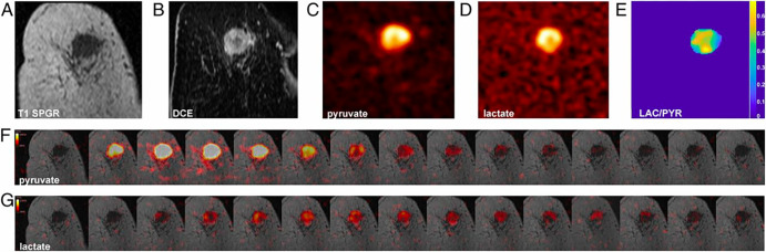 Hyperpolarized [1–carbon 13]pyruvate MR images in a patient with triple-negative breast cancer. (A) Coronal T1-weighted three-dimensional spoiled gradient-echo (SPGR) image. (B) Coronal reformatted dynamic contrast-enhanced (DCE) image at peak enhancement after injection of a gadolinium-based contrast agent. (C) Summed hyperpolarized carbon 13 pyruvate images. (D) Summed hyperpolarized carbon 13 lactate images. (E) Lactate:pyruvate (LAC/PYR) ratio map. (F, G) Dynamic hyperpolarized carbon 13 pyruvate and lactate imaging with a 12-second delay after injection over 15 time points at 4-second intervals. (Reprinted, with permission, from reference 18.)