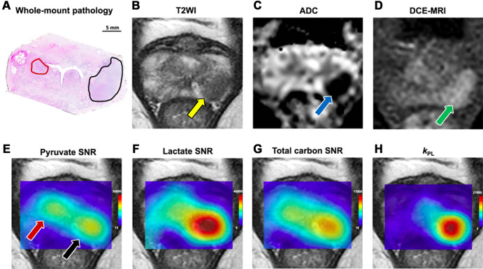 Images in a 64-year-old patient who underwent robot-assisted radical prostatectomy. (A) Postsurgical histopathologic assessment confirmed the diagnosis of adenocarcinoma of the prostate. The red region of interest represents an International Society of Urological Pathology (ISUP) grade 1 lesion in the right peripheral zone, and the black region of interest represents a ISUP grade 3 lesion in the left peripheral zone. (B) T2-weighted MR (T2WI) image demonstrates a single marked area of low signal intensity corresponding to the target lesion in the left peripheral zone (yellow arrow). (C) Apparent diffusion coefficient (ADC) map demonstrates a corresponding focus of markedly restricted diffusion in the left peripheral zone (blue arrow). (D) Dynamic contrast-enhanced (DCE) MR image demonstrates the area of early enhancement in the left peripheral zone (green arrow). (E) Pyruvate signal-to-noise ratio (SNR) map with two areas of high pyruvate signal intensity, with the red and black arrows corresponding to the grade 1 and grade 3 histopathology-confirmed tumor foci, respectively. (F) Lactate SNR map demonstrates high [1–carbon 13]lactate signal intensity in the left peripheral zone lesion. (G) Total carbon SNR map shows higher signal intensity in the left peripheral zone tumor. (H) The apparent exchange rate constant for lactate dehydrogenase (kPL) map (presented as sec-1) shows a higher rate of pyruvate-to-lactate conversion in the more aggressive left peripheral zone lesion. (Reprinted, under a CC BY 4.0 license, from reference 16.)
