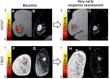 Two patients with human epidermal growth factor receptor
2–positive (HER2+) breast cancer (top row) and triple-negative breast
cancer (TNBC) (bottom row). (A, F) Hyperpolarized carbon 13 MRI
lactate:pyruvate (LAC/PYR) maps for both patients superimposed on hydrogen 1
MR images. (B, G) Diffusion images at baseline. Early follow-up (C, H)
hyperpolarized and (D, I) diffusion images. Differences between baseline and
follow-up images were significant for tumor volume and diffusivity.
(Reprinted, under a CC BY 4.0 license, from reference 30.)