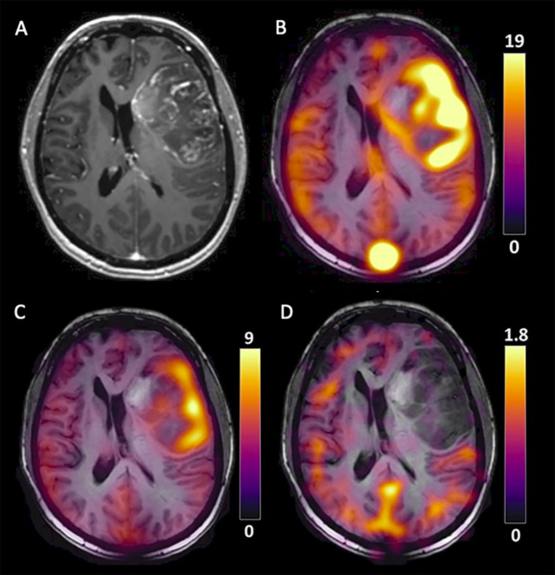 Hyperpolarized carbon 13 MR images in a patient with glioblastoma that demonstrate heterogeneity in metabolism. (A) Axial contrast-enhanced T1-weighted fast spoiled gradient-echo image through the center of the lesion and (B) overlaid with the pyruvate, (C) lactate, and (D) bicarbonate color maps all summed over the imaging time course. (Reprinted, under a CC BY 4.0 license, from reference 20.)
