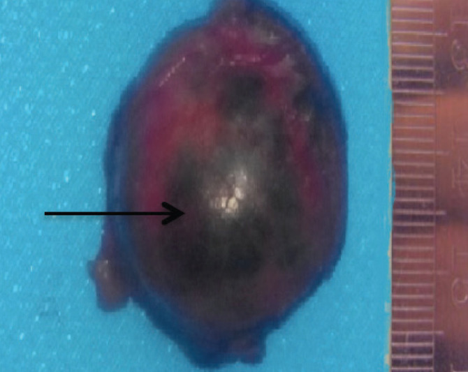 Juxtaglomerular cell cause of secondary hypertension in an adolescent pmc